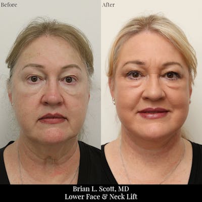 Facelift Before & After Gallery - Patient 427752 - Image 1