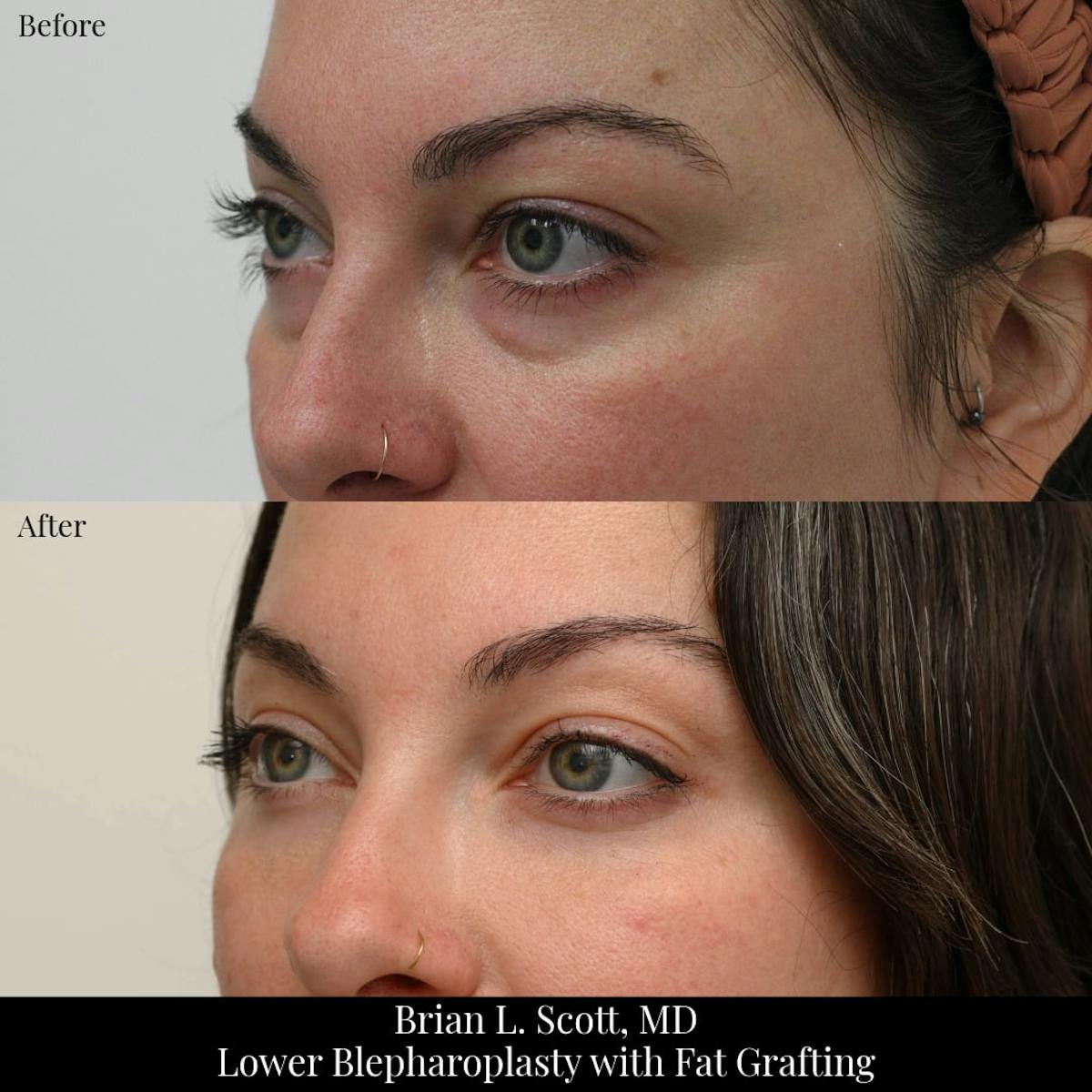 Facial Fat Transfer Before & After Gallery - Patient 394200 - Image 2