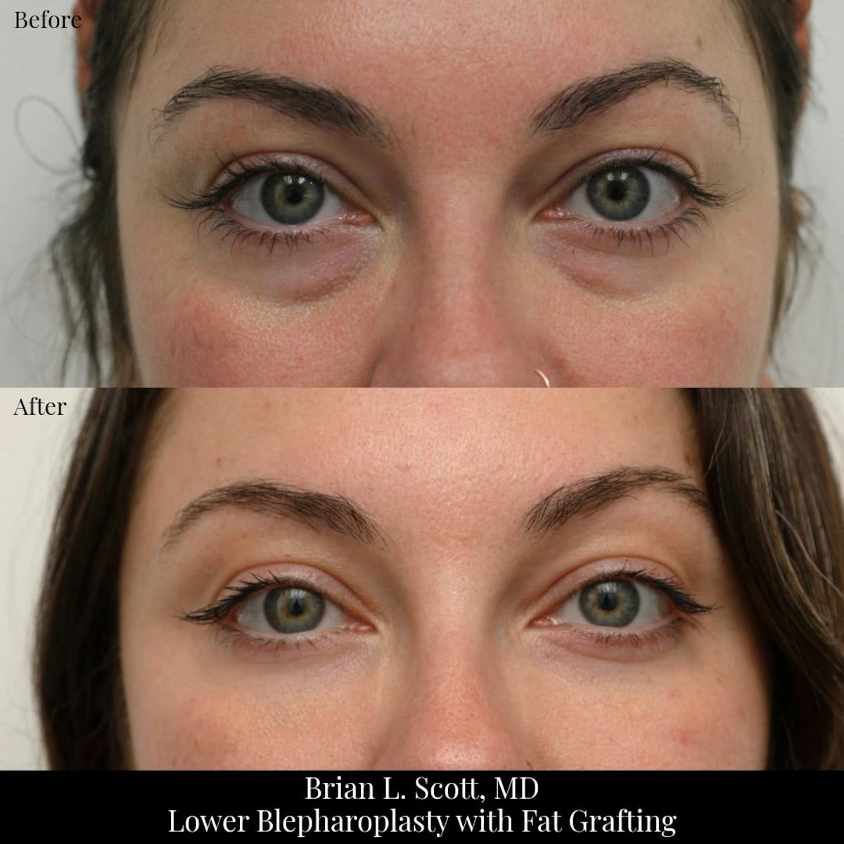 Facial Fat Transfer Before & After Gallery - Patient 394200 - Image 3
