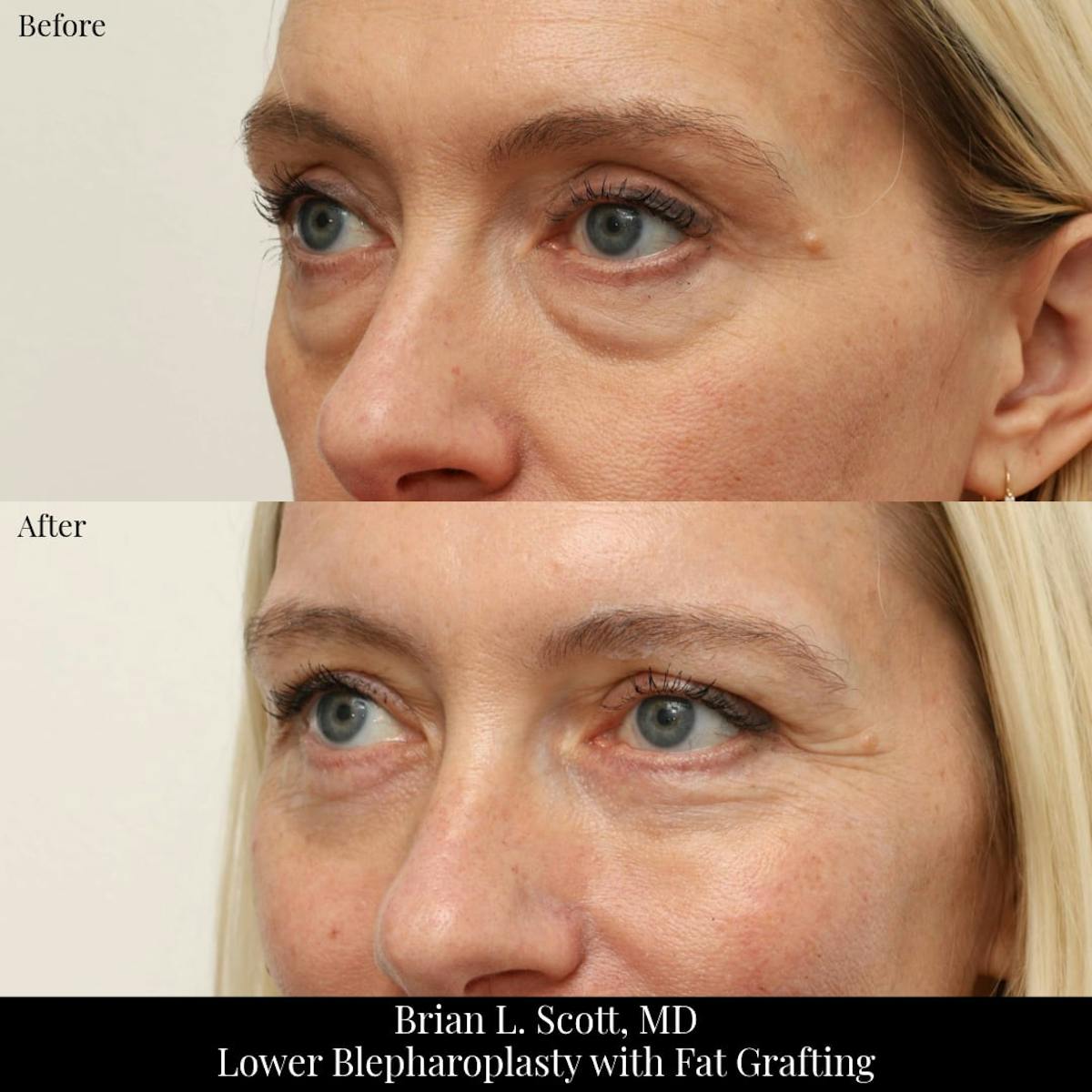 Lower Blepharoplasty Before & After Gallery - Patient 344275 - Image 3
