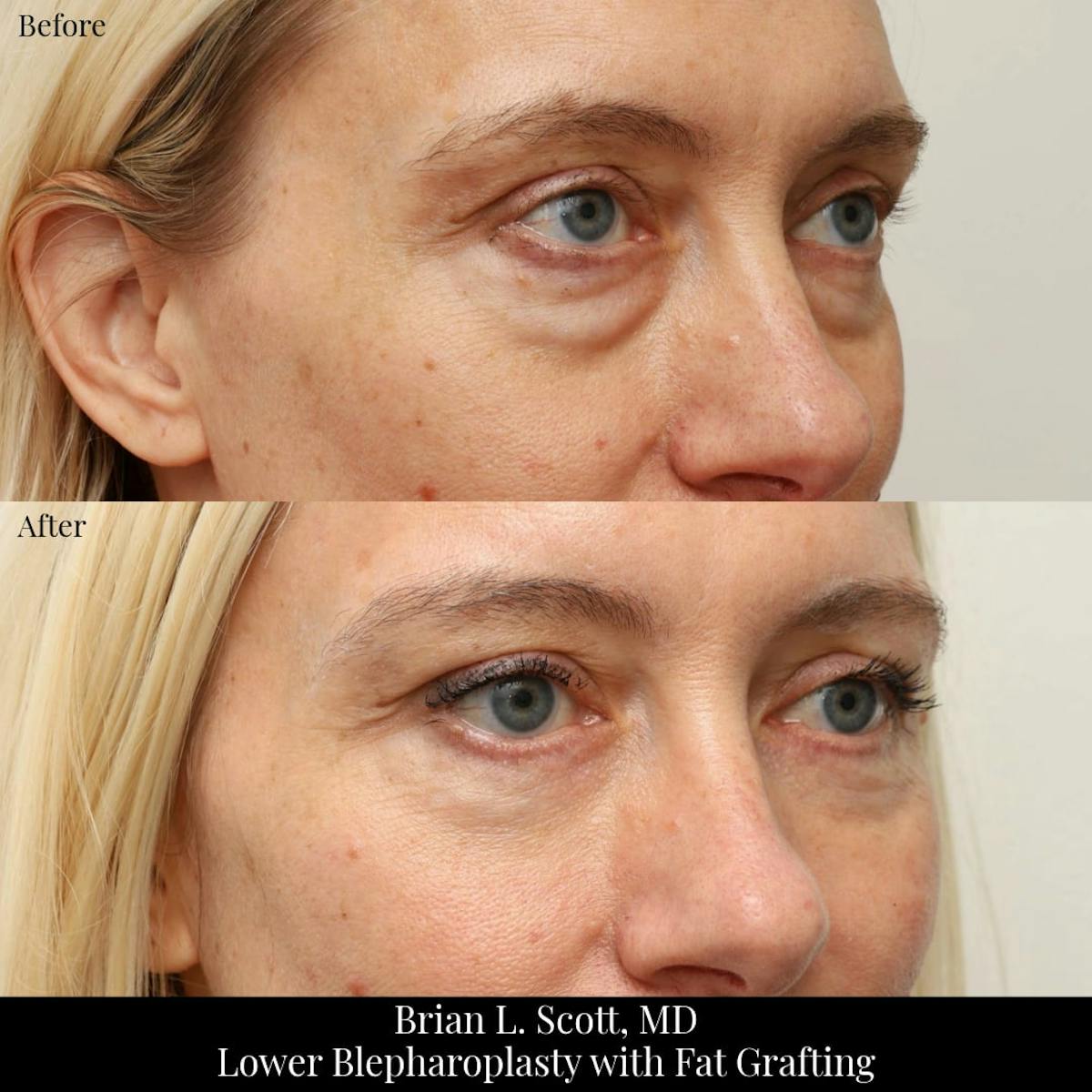 Lower Blepharoplasty Before & After Gallery - Patient 344275 - Image 2