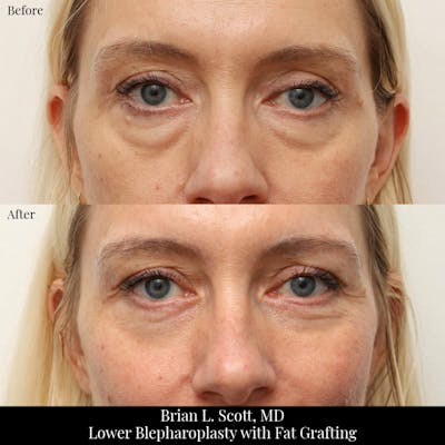 Facial Fat Transfer Before & After Gallery - Patient 212525 - Image 1