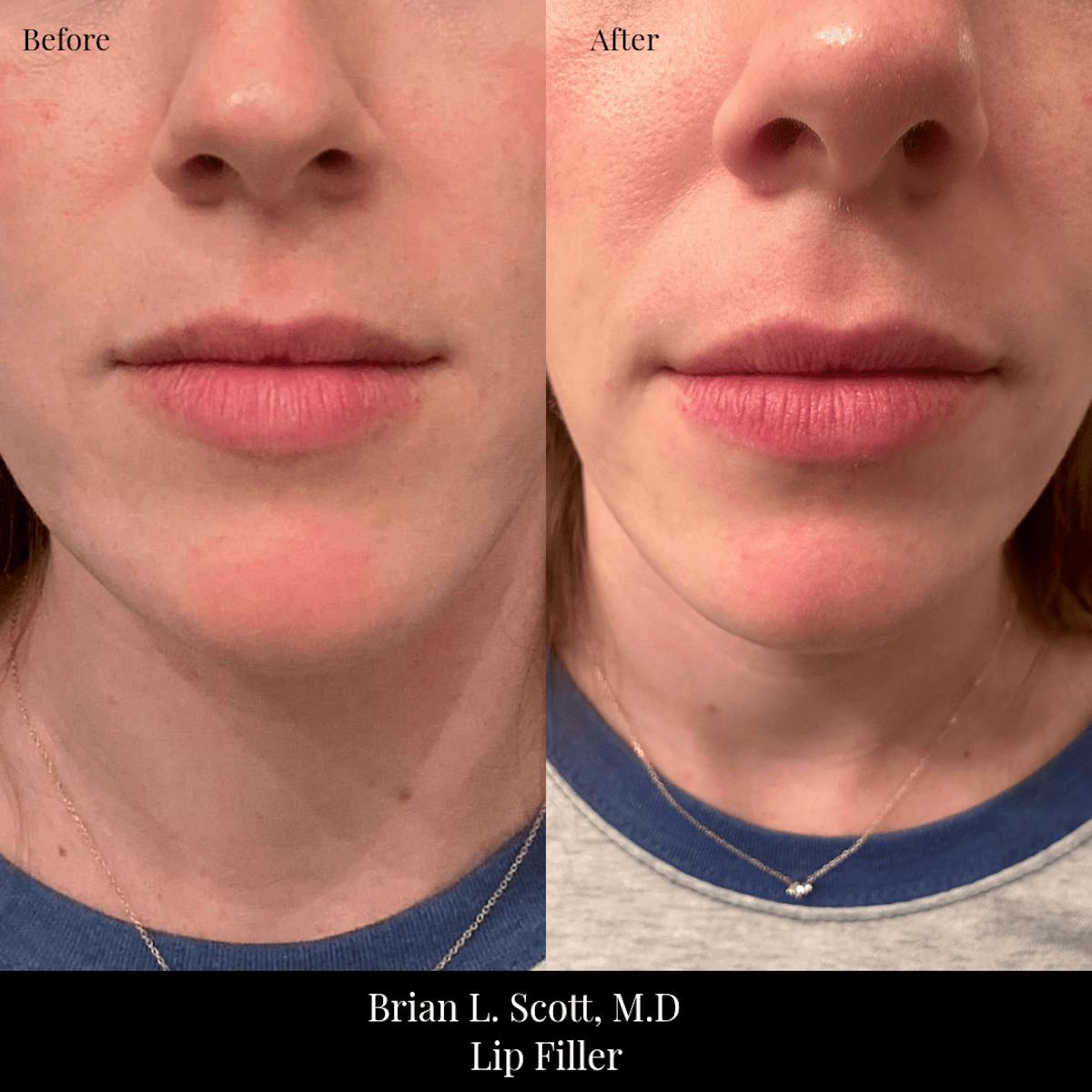 Fillers Before & After Gallery - Patient 479094 - Image 1