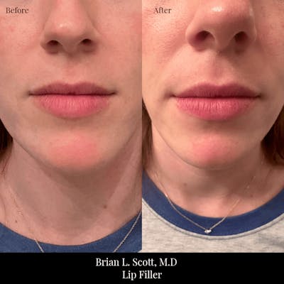 Fillers Before & After Gallery - Patient 479094 - Image 1
