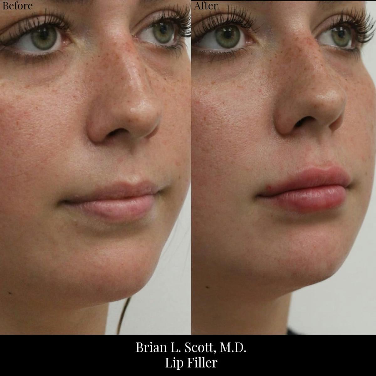 Fillers Before & After Gallery - Patient 408010 - Image 1