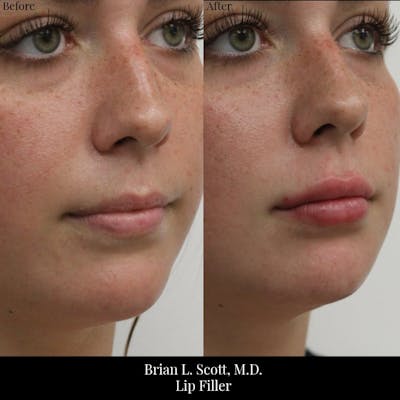 Fillers Before & After Gallery - Patient 408010 - Image 1