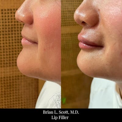 Fillers Before & After Gallery - Patient 204906 - Image 1