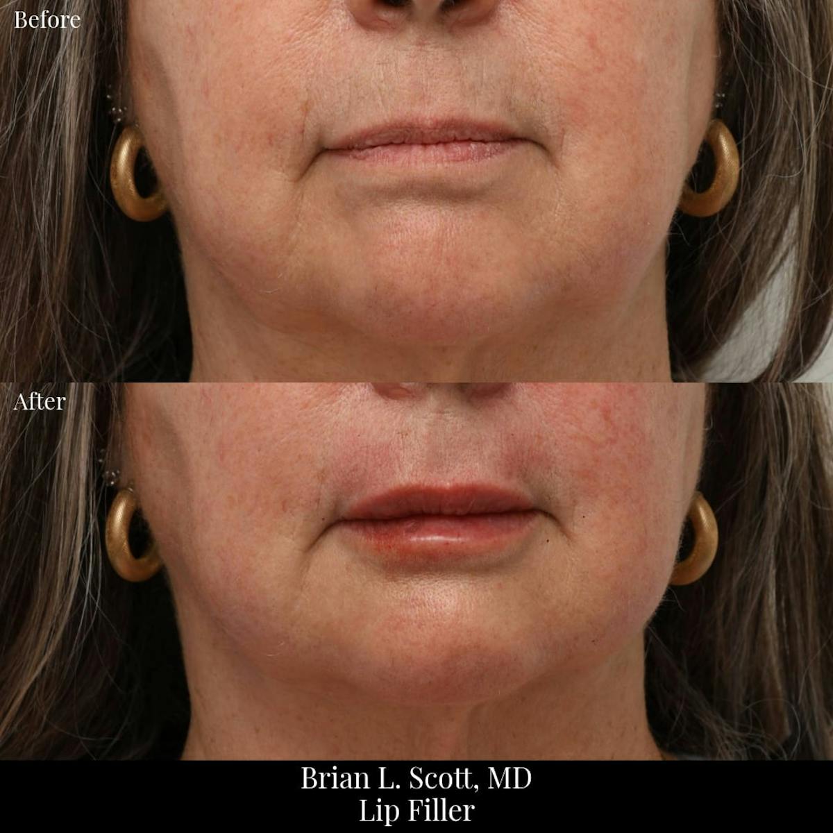 Fillers Before & After Gallery - Patient 391627 - Image 1