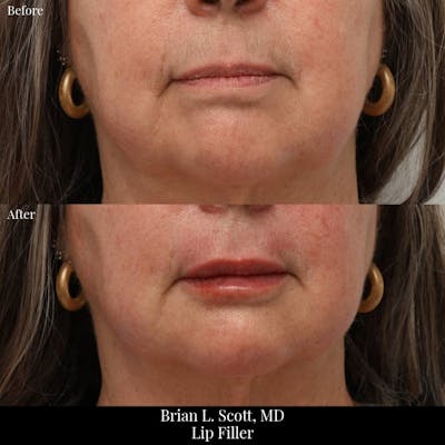 Fillers Before & After Gallery - Patient 391627 - Image 1