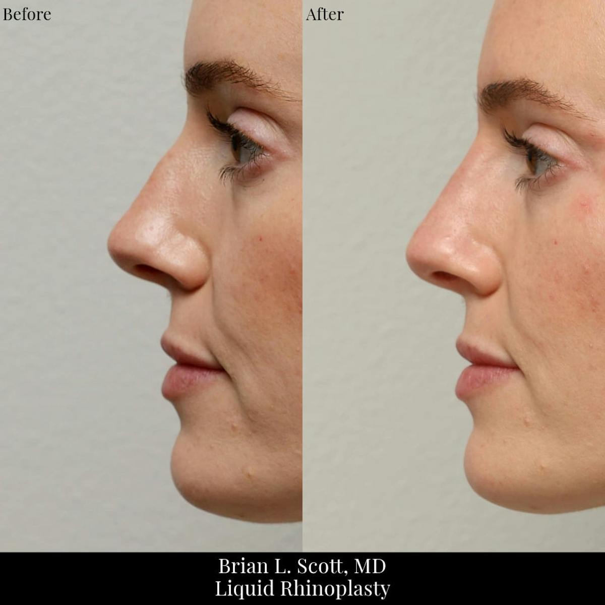 Liquid Rhinoplasty (Filler)  Before & After Gallery - Patient 425575 - Image 1