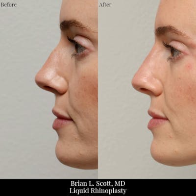 Liquid Rhinoplasty (Filler)  Before & After Gallery - Patient 425575 - Image 1