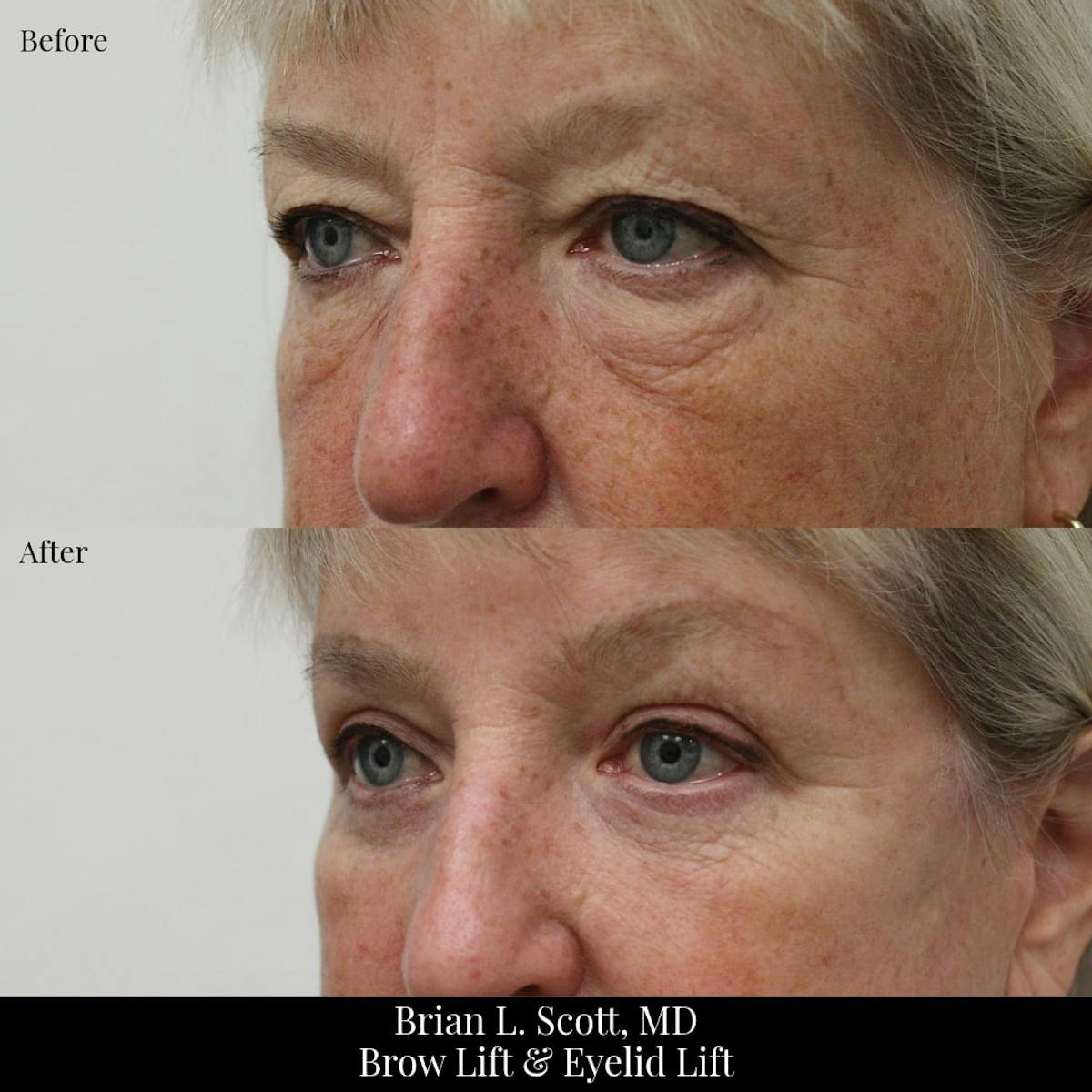 Lower Blepharoplasty Before & After Gallery - Patient 269349 - Image 2