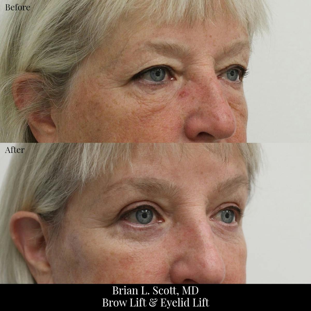 Lower Blepharoplasty Before & After Gallery - Patient 269349 - Image 3