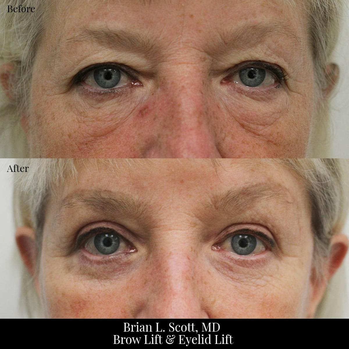 Lower Blepharoplasty Before & After Gallery - Patient 269349 - Image 1