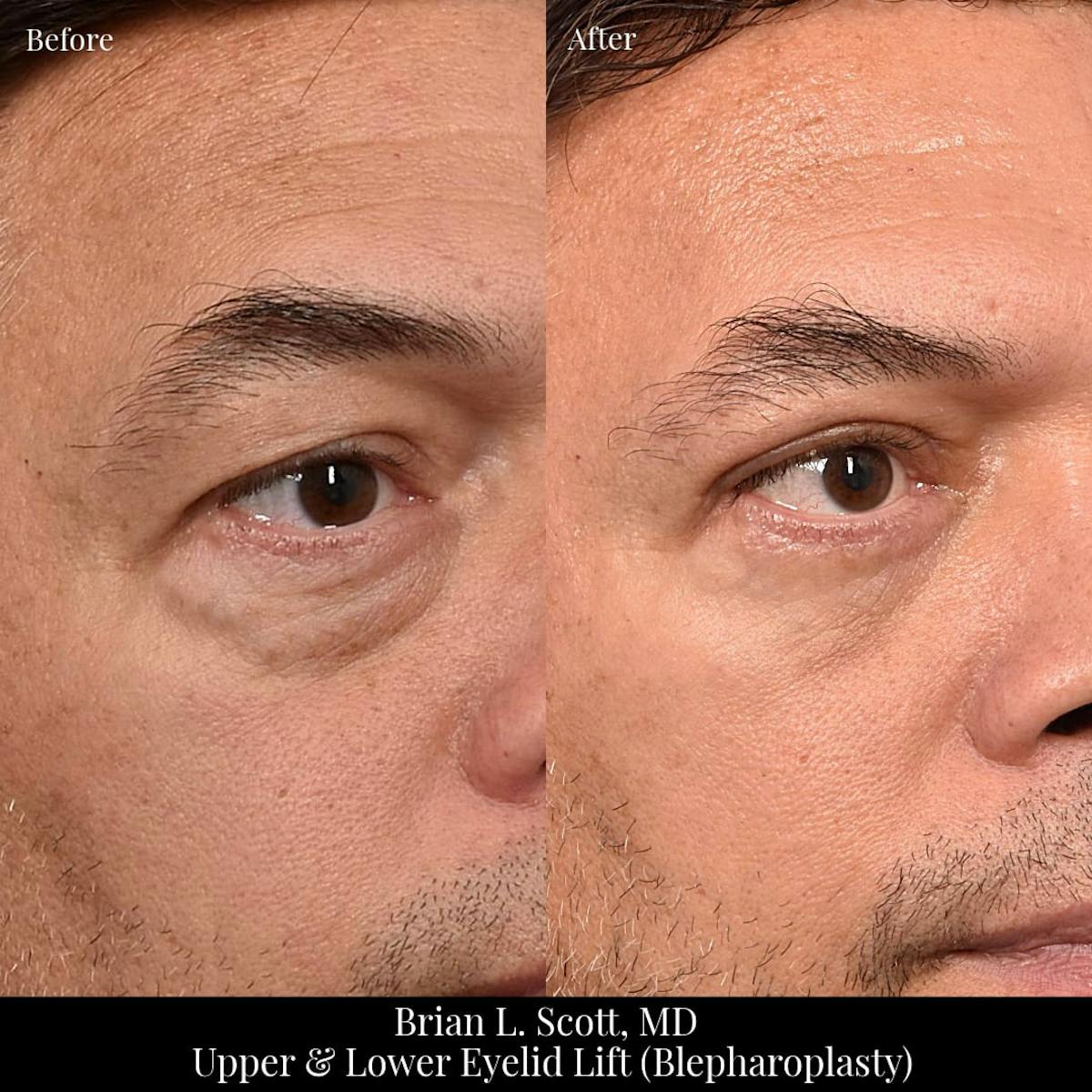 Lower Blepharoplasty Before & After Gallery - Patient 274349 - Image 1