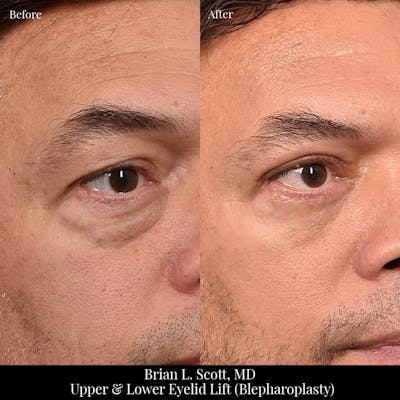 Lower Blepharoplasty Before & After Gallery - Patient 274349 - Image 1