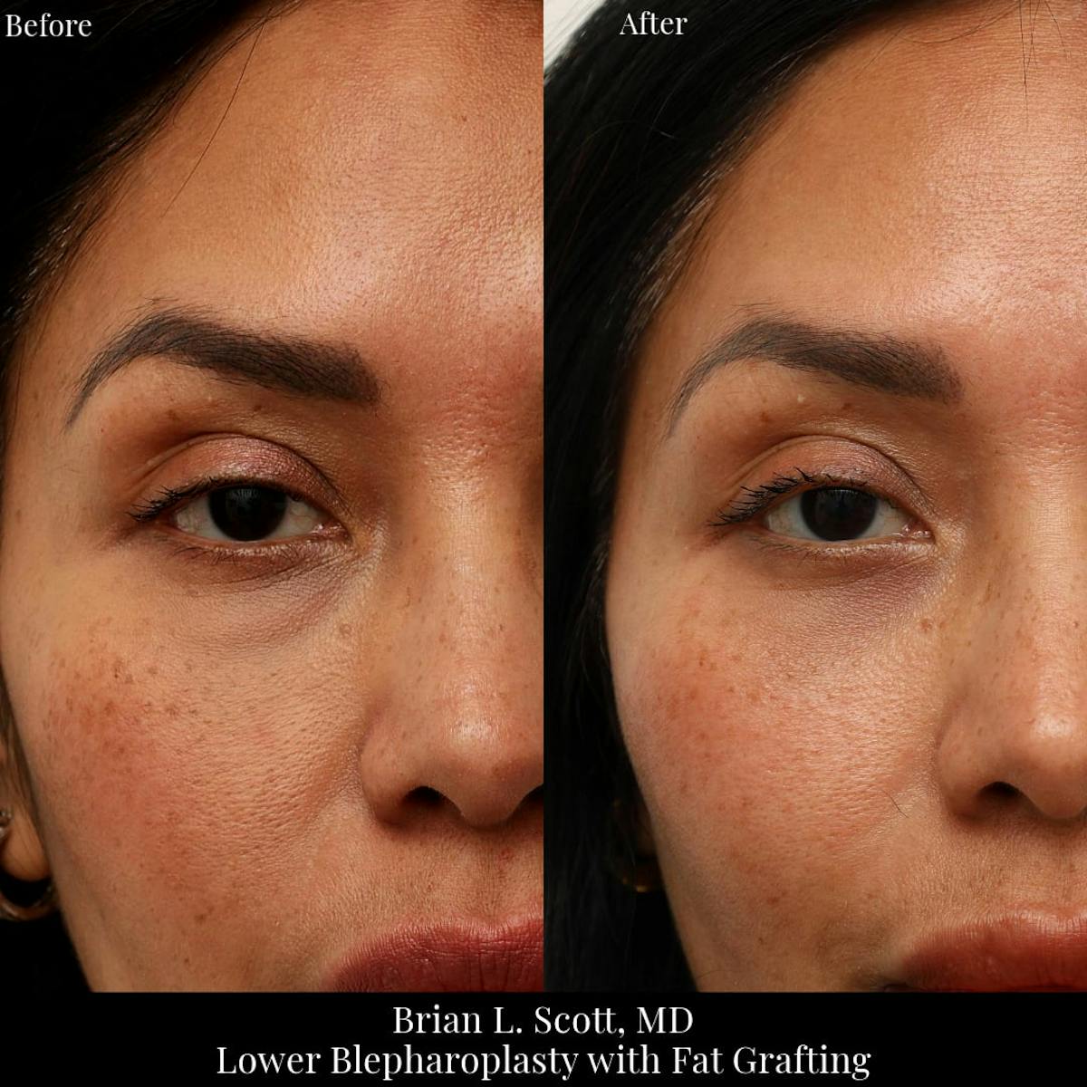 Lower Blepharoplasty Before & After Gallery - Patient 206948 - Image 1