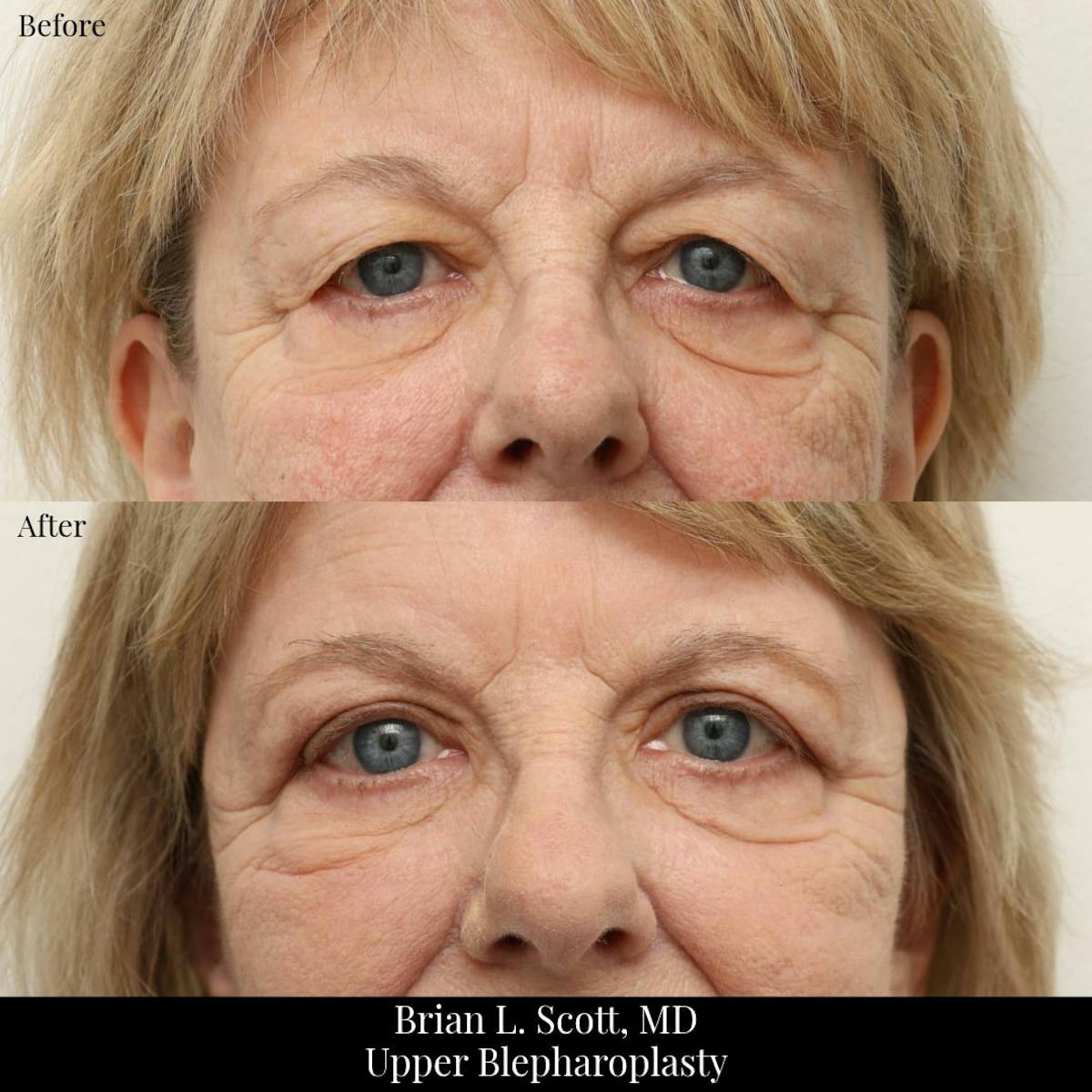Upper Blepharoplasty Before & After Gallery - Patient 319517 - Image 1