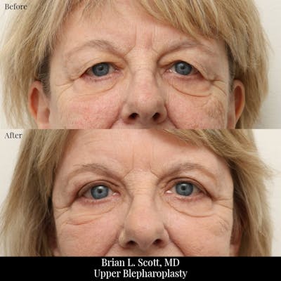 Upper Blepharoplasty Before & After Gallery - Patient 319517 - Image 1