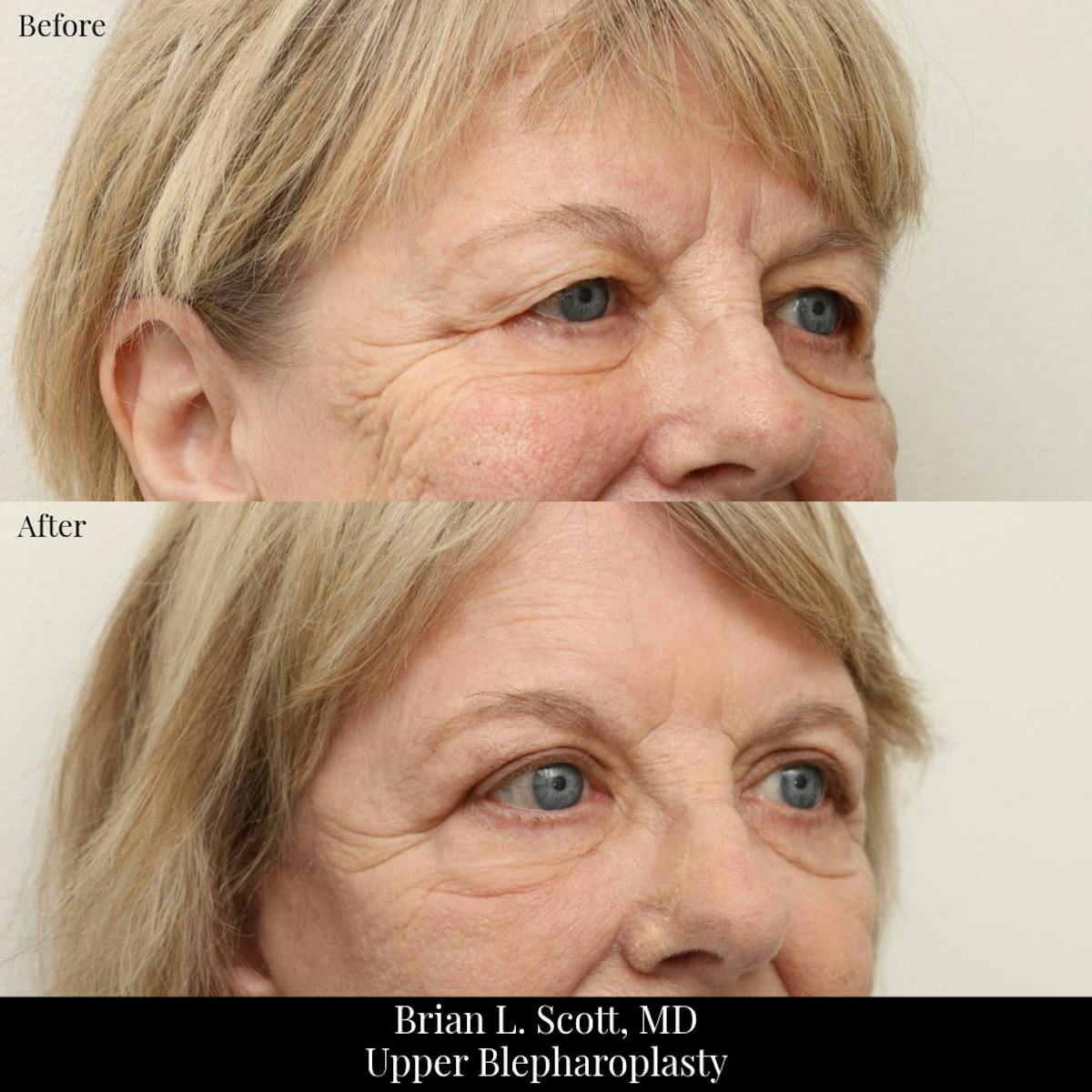 Upper Blepharoplasty Before & After Gallery - Patient 319517 - Image 2