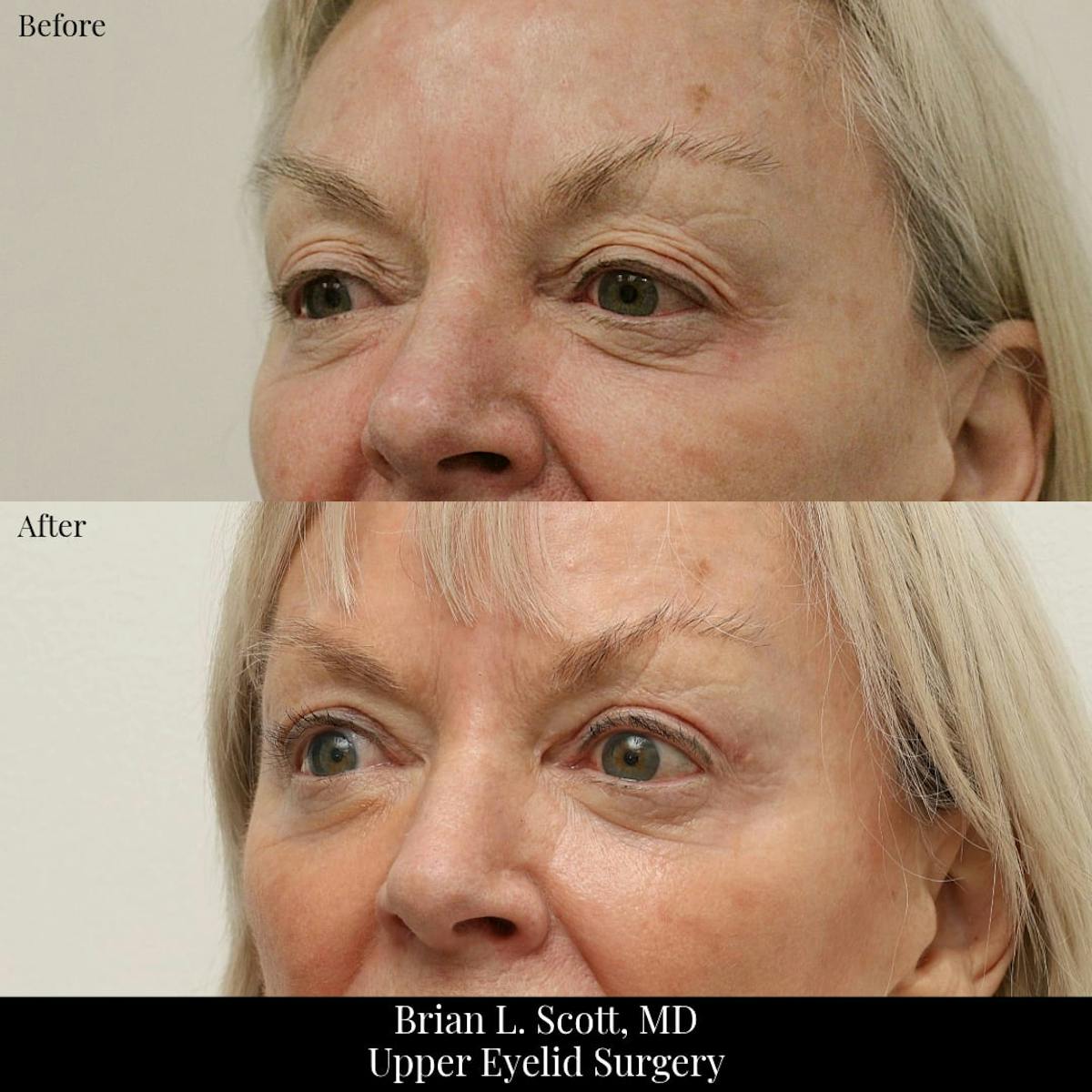 Upper Blepharoplasty Before & After Gallery - Patient 421359 - Image 1