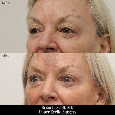Upper Blepharoplasty Before & After Gallery - Patient 421359 - Image 1