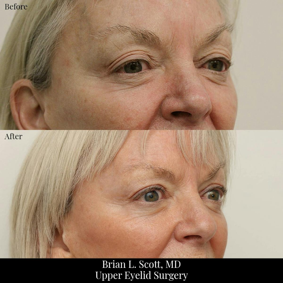 Upper Blepharoplasty Before & After Gallery - Patient 421359 - Image 2