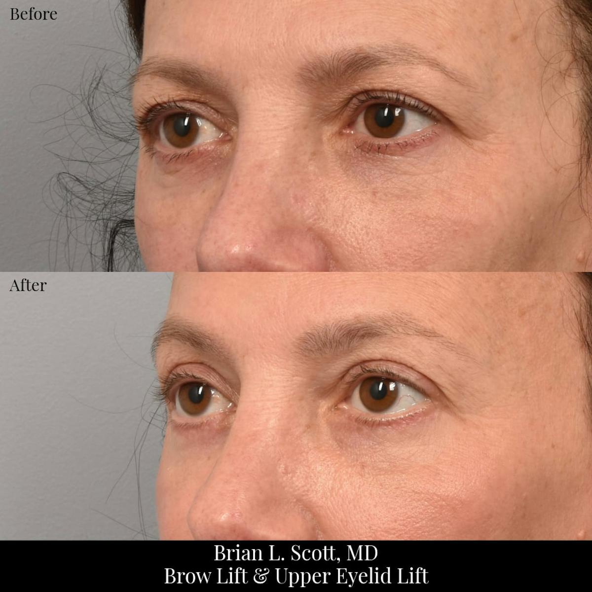 Upper Blepharoplasty Before & After Gallery - Patient 249738 - Image 1