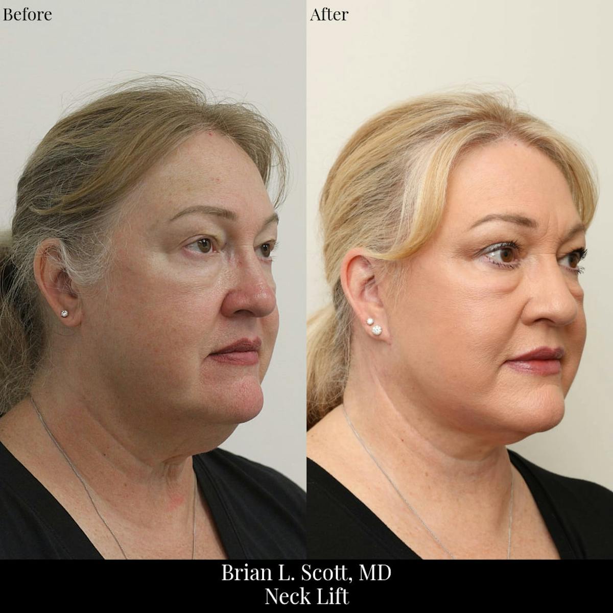 Neck Lift Before & After Gallery - Patient 416640 - Image 2