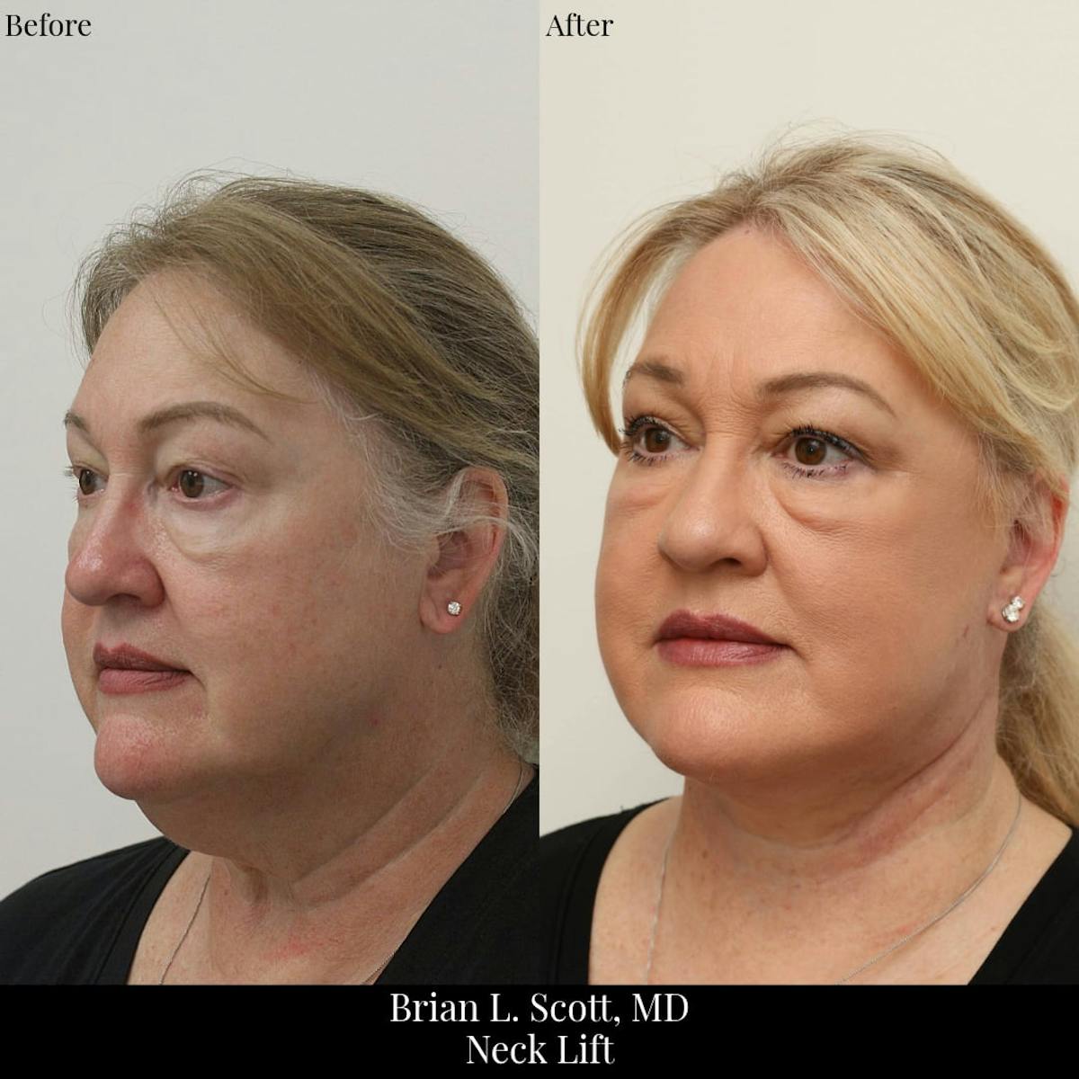 Neck Lift Before & After Gallery - Patient 416640 - Image 3