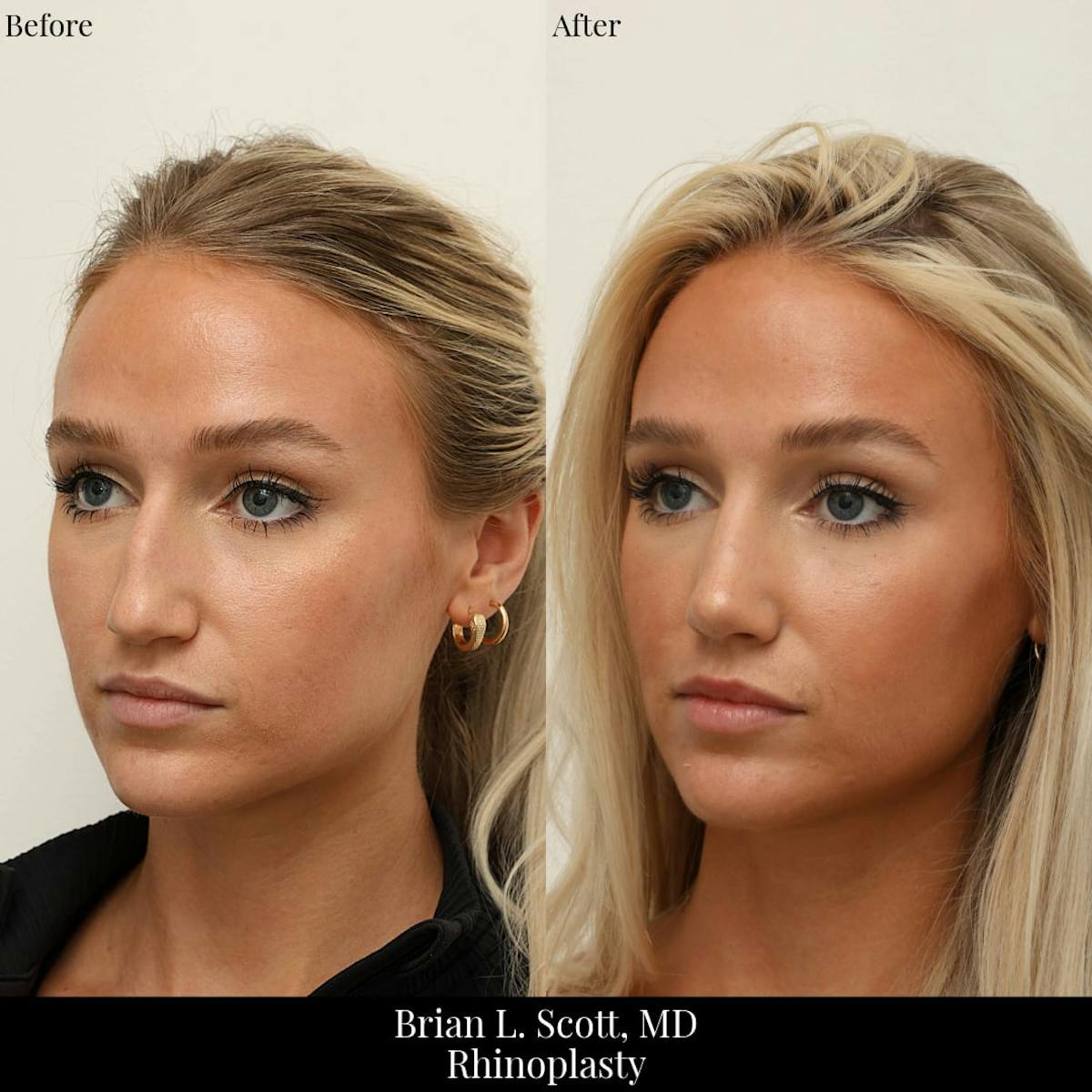 Rhinoplasty Before & After Gallery - Patient 101197 - Image 2