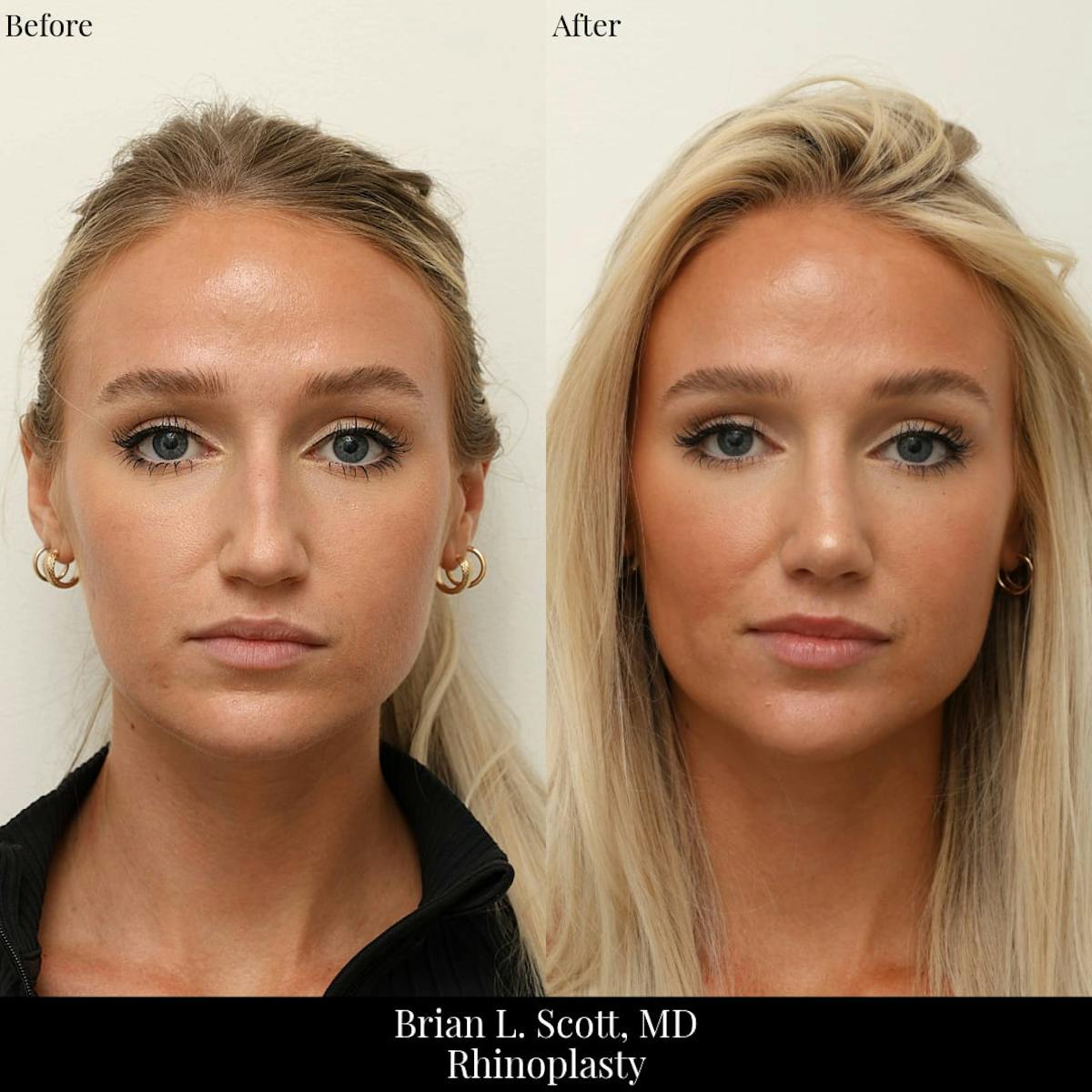 Rhinoplasty Before & After Gallery - Patient 101197 - Image 3