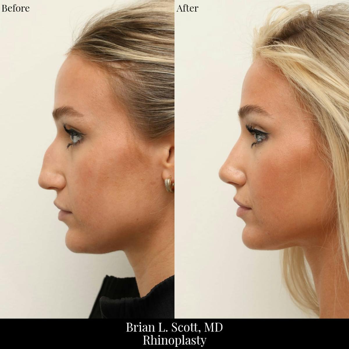 Rhinoplasty Before & After Gallery - Patient 101197 - Image 1
