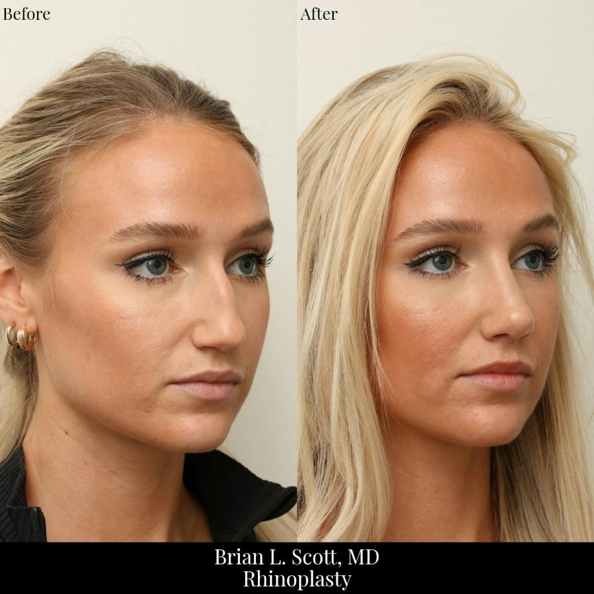 Rhinoplasty Before & After Gallery - Patient 101197 - Image 4