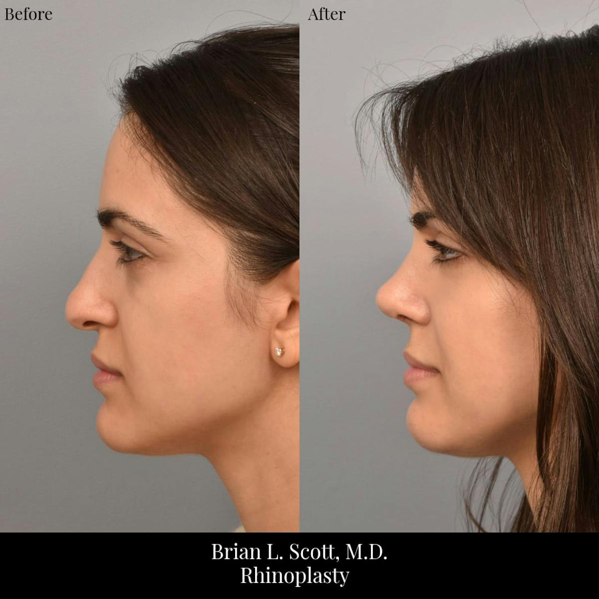 Rhinoplasty Before & After Gallery - Patient 260592 - Image 1