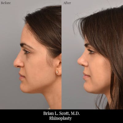 Rhinoplasty Before & After Gallery - Patient 260592 - Image 1
