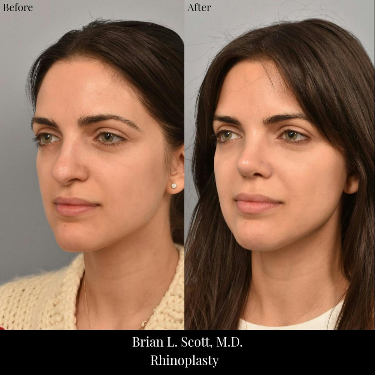 Rhinoplasty Before & After Gallery - Patient 260592 - Image 2