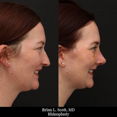 Rhinoplasty Before & After Gallery - Patient 304238 - Image 1