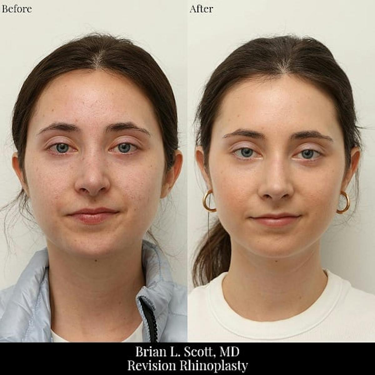 Rhinoplasty Before & After Gallery - Patient 371220 - Image 3