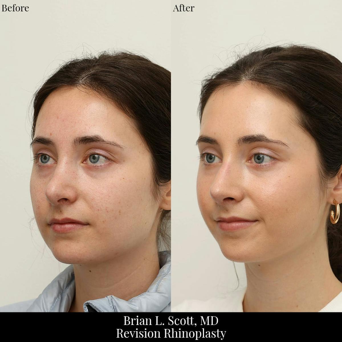 Rhinoplasty Before & After Gallery - Patient 371220 - Image 2