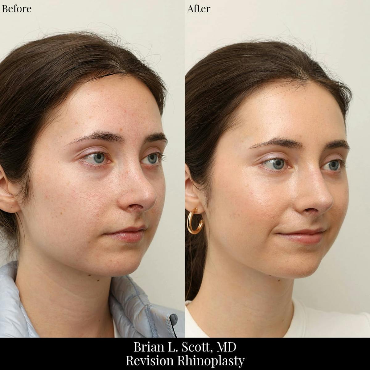 Rhinoplasty Before & After Gallery - Patient 371220 - Image 4