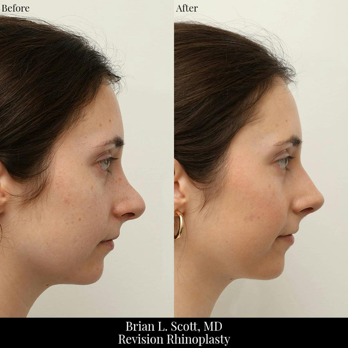 Rhinoplasty Before & After Gallery - Patient 371220 - Image 5