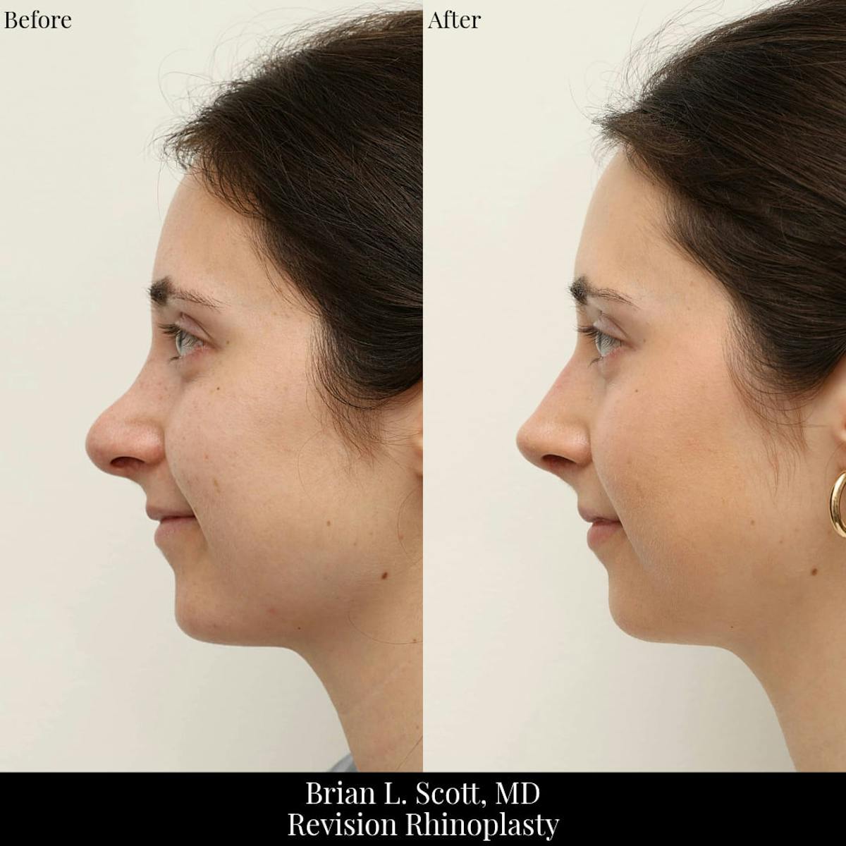 Rhinoplasty Before & After Gallery - Patient 371220 - Image 1