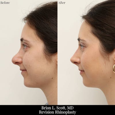Rhinoplasty Before & After Gallery - Patient 371220 - Image 1