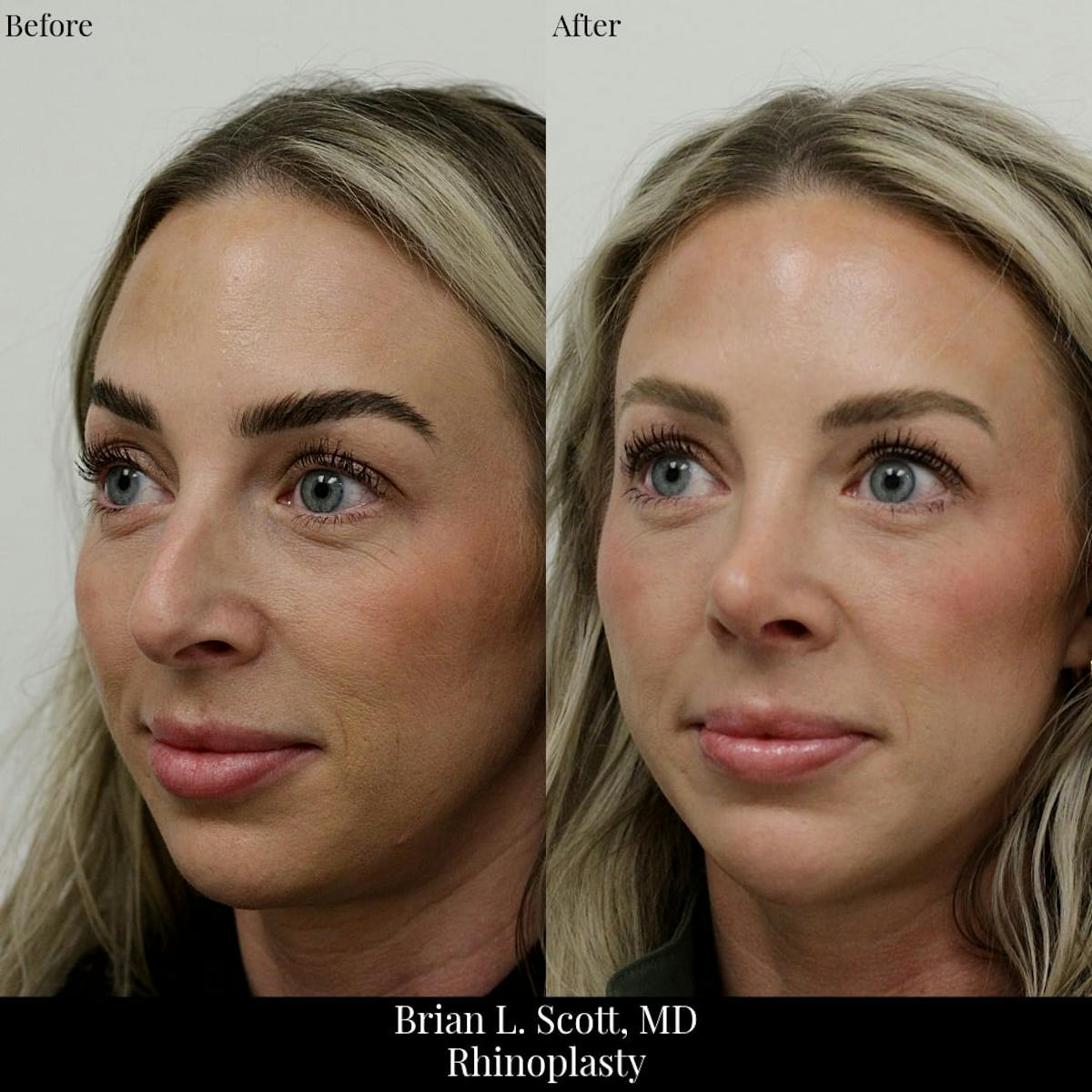 Rhinoplasty Before & After Gallery - Patient 327982 - Image 2