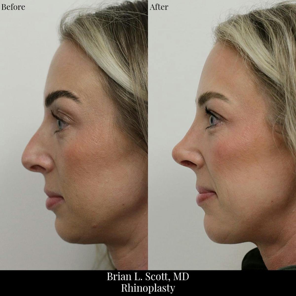 Rhinoplasty Before & After Gallery - Patient 327982 - Image 1
