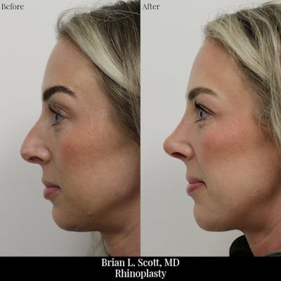 Rhinoplasty Before & After Gallery - Patient 327982 - Image 1