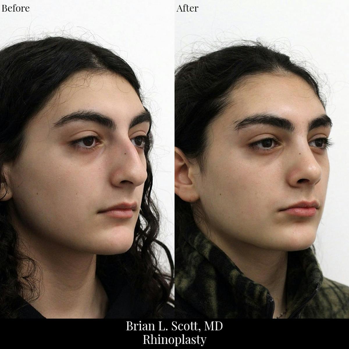 Rhinoplasty Before & After Gallery - Patient 258403 - Image 4