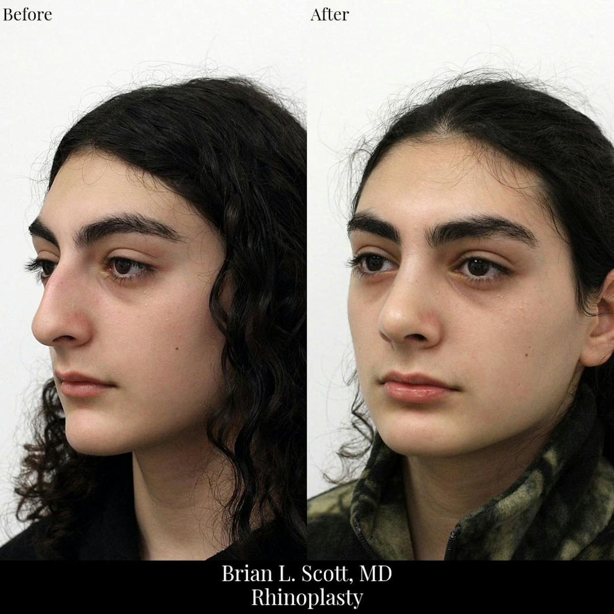 Rhinoplasty Before & After Gallery - Patient 258403 - Image 2