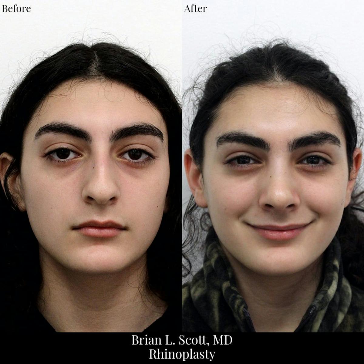 Rhinoplasty Before & After Gallery - Patient 258403 - Image 3